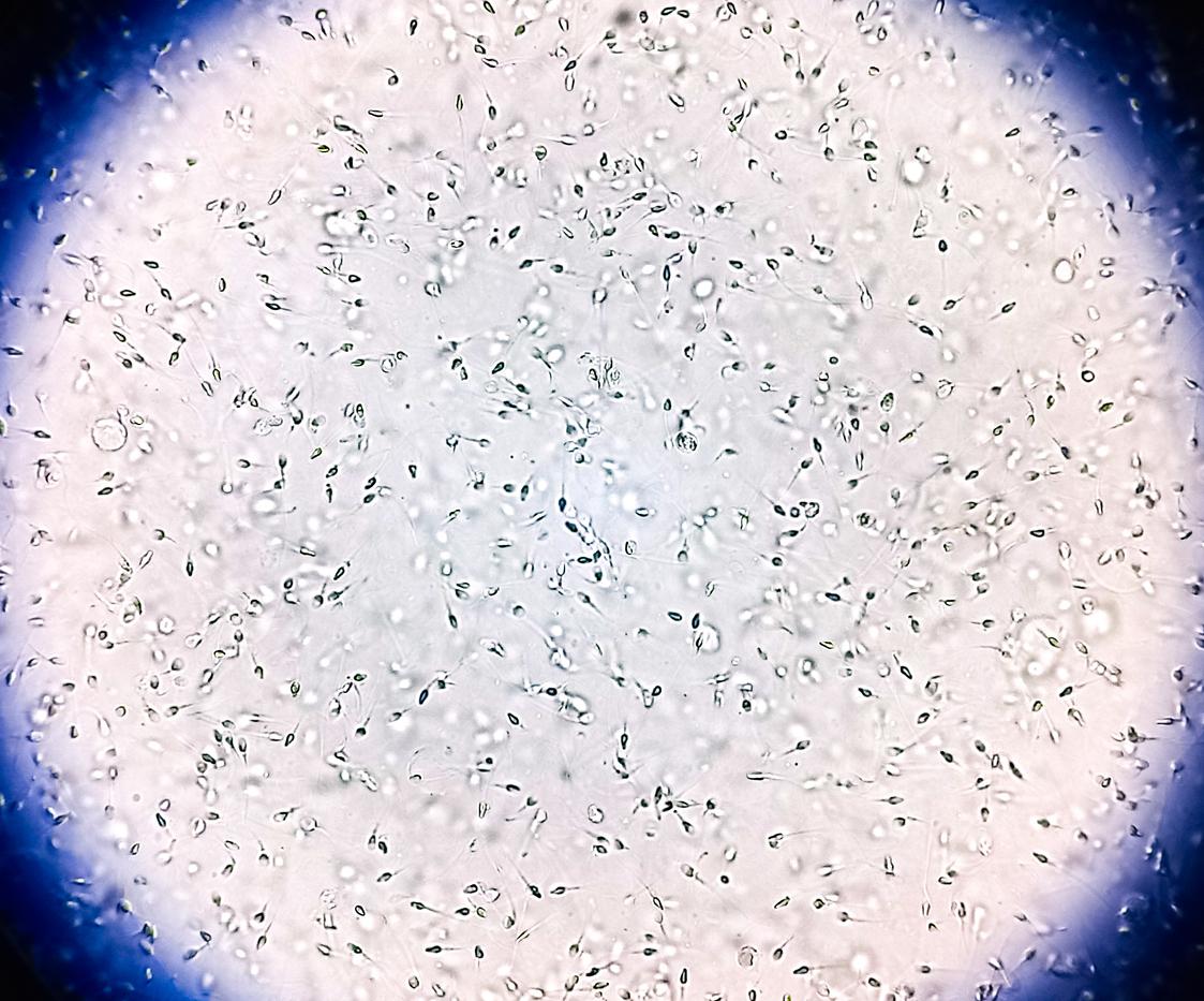 Everything you need to know about microTESE for male infertility